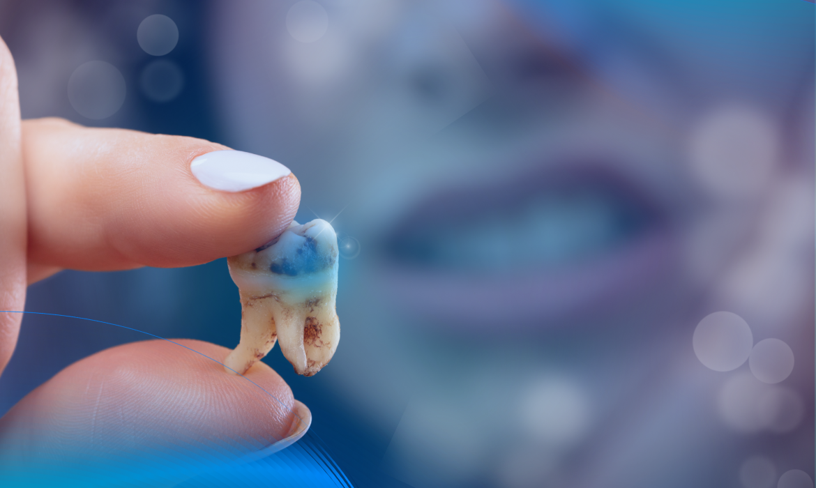 ¿Si tengo una carie, es porque como mucha azúcar?